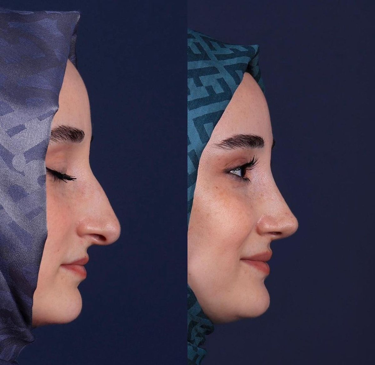Resultados de rinoplastia antes y después en Private Yüzyıl Hospital, perfil nasal mejorado