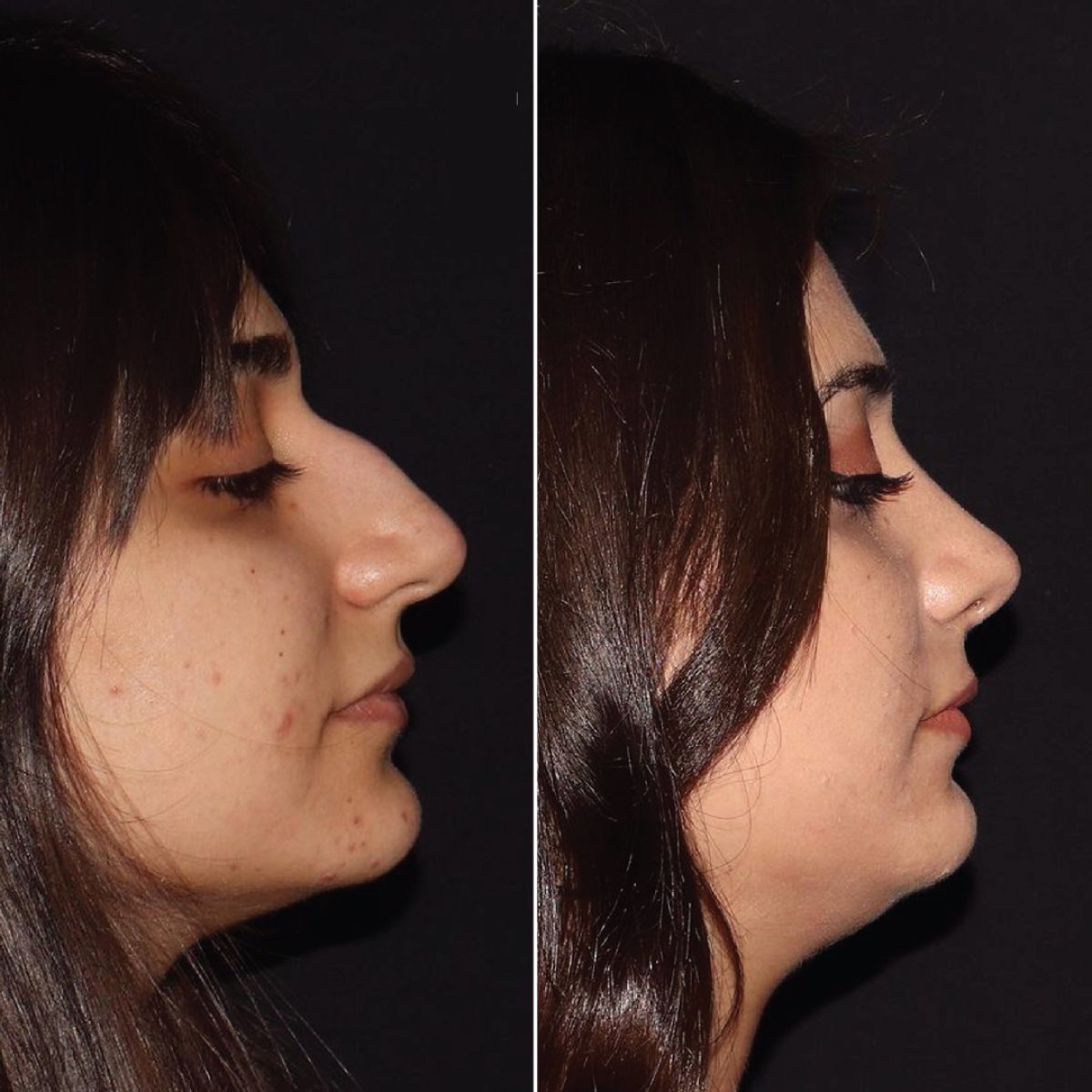 Before and after rhinoplasty results at Private Yüzyıl Hospital, improved nose profile