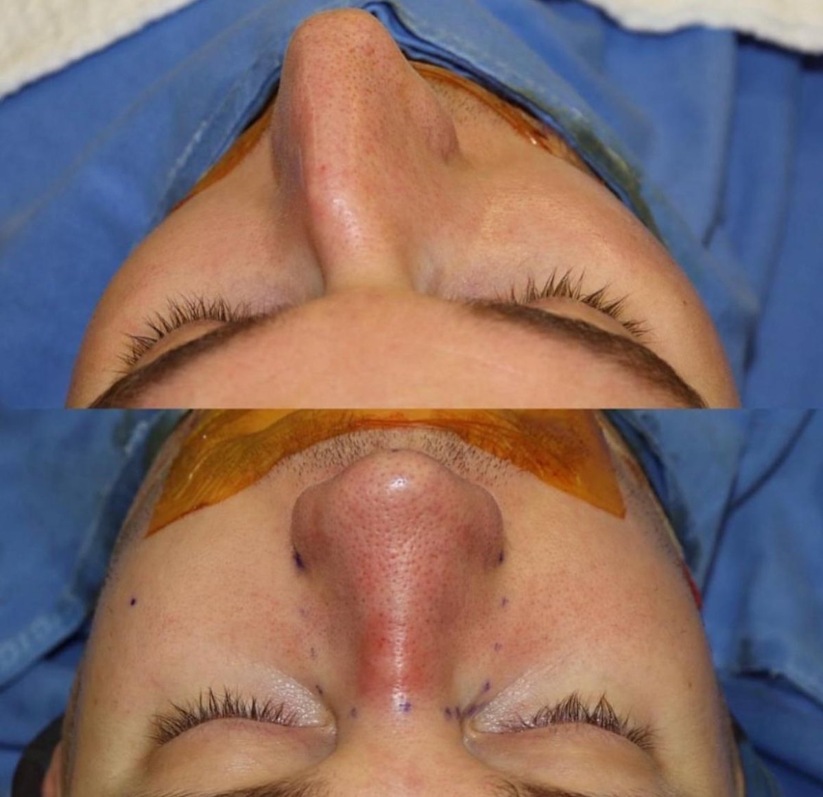 نتائج عملية تجميل الأنف قبل وبعد في مستشفى Private Yüzyıl، إعادة تشكيل الأنف