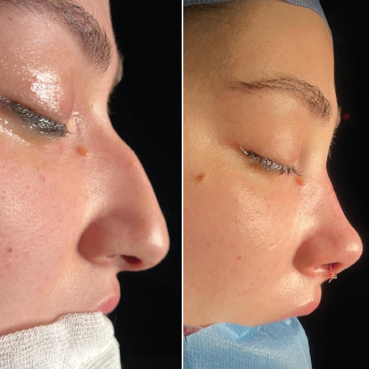 نتائج عملية تجميل الأنف قبل وبعد في مستشفى Private Yüzyıl، إعادة تشكيل الأنف