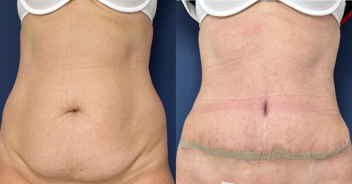 Resultados de abdominoplastia antes y después en Private Yüzyıl Hospital, abdomen plano
