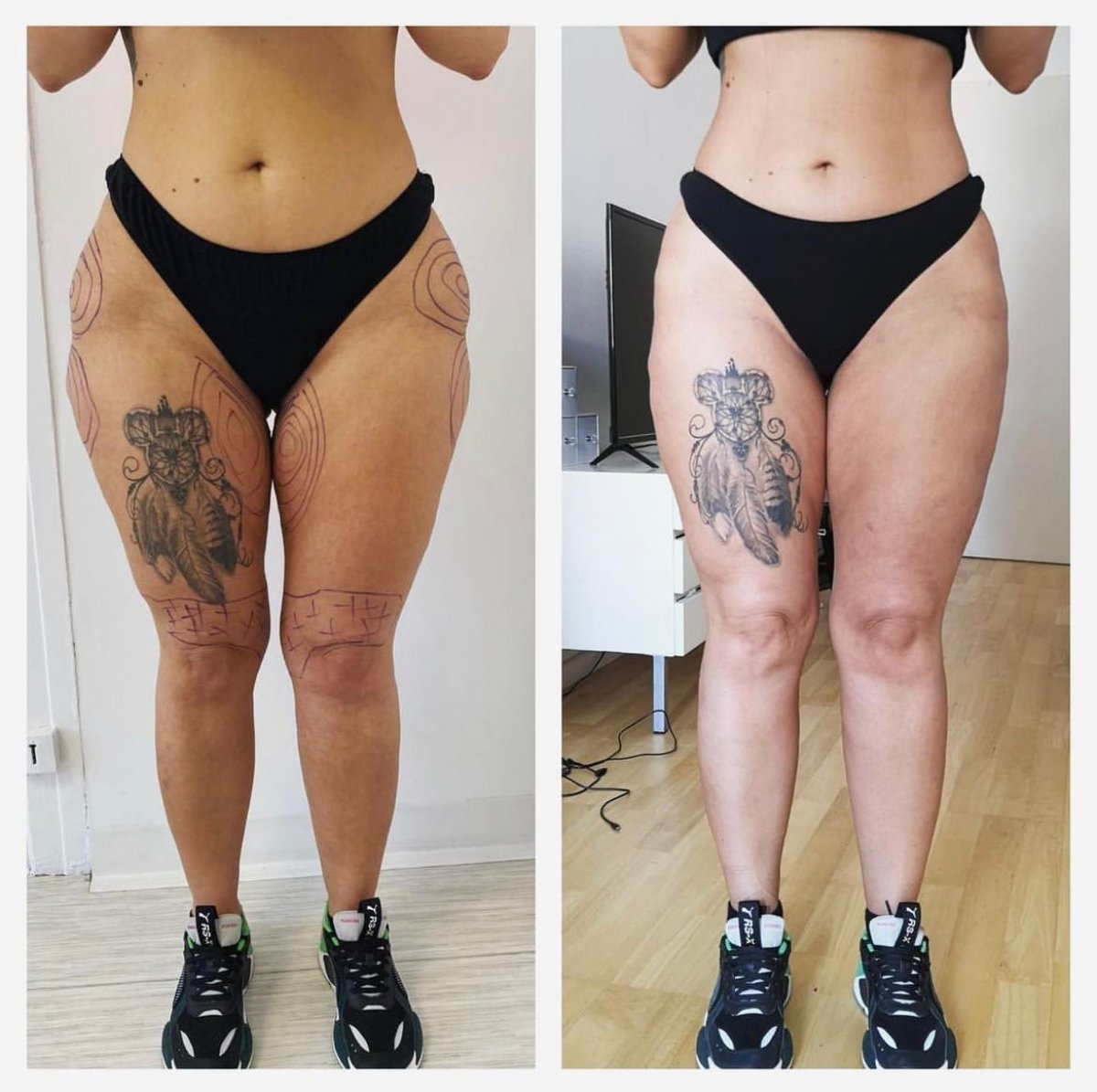 Resultados de lifting de muslos antes y después en Private Yüzyıl Hospital, contorno mejorado