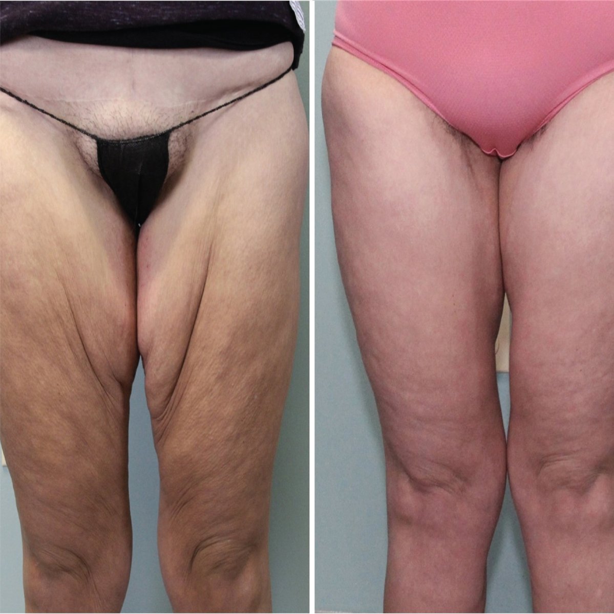 Resultados de lifting de muslos antes y después en Private Yüzyıl Hospital, mejor contorno