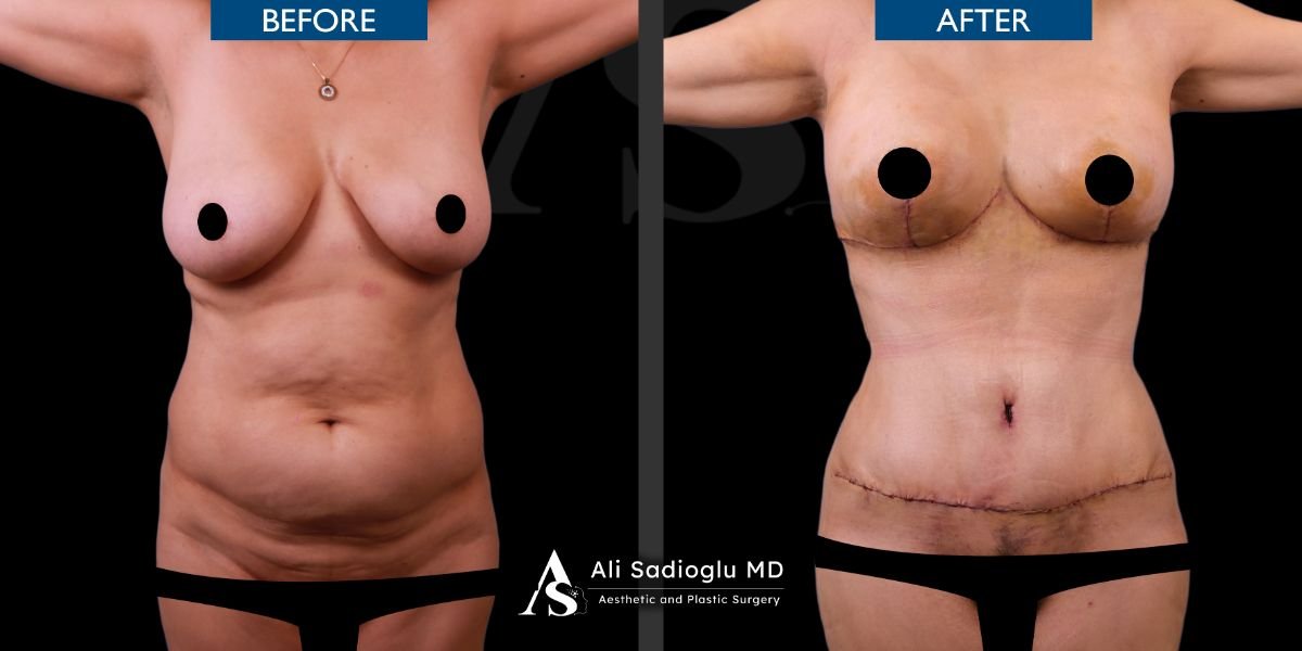 Before and after mommy makeover results at Dr. Safa Manav Clinic, body contour improvement
