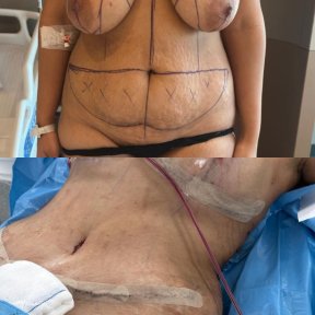 Tummy Tuck for Flat & Toned Abdomen — 5★ Hotel & VIP Transfer Included - photo 5
