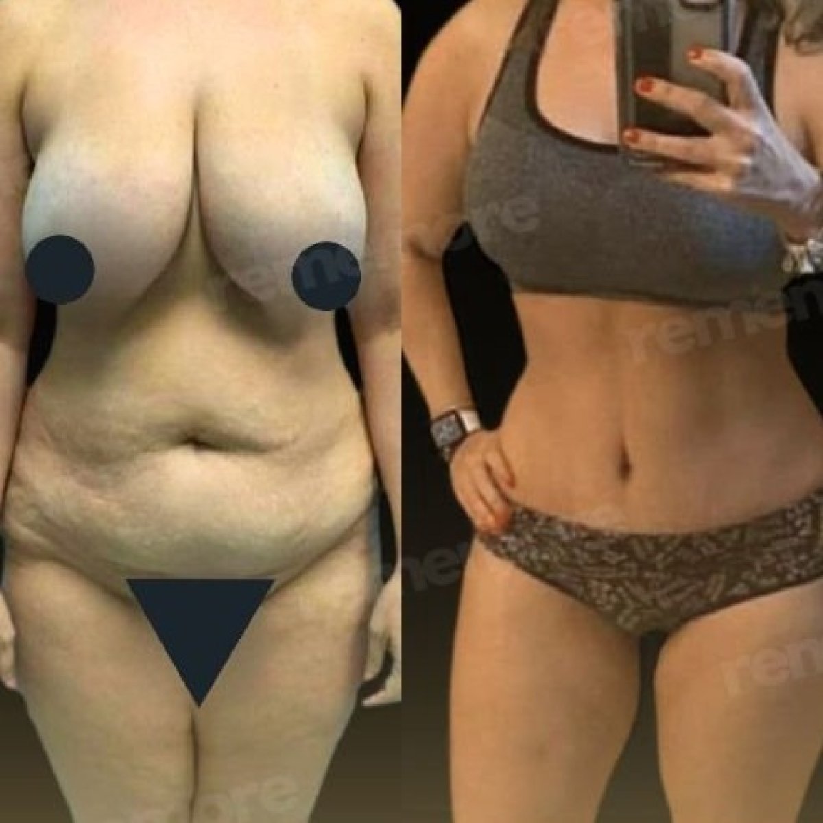 Resultados de abdominoplastia antes y después en Memorial Bahçelievler Hospital, abdomen mejorado