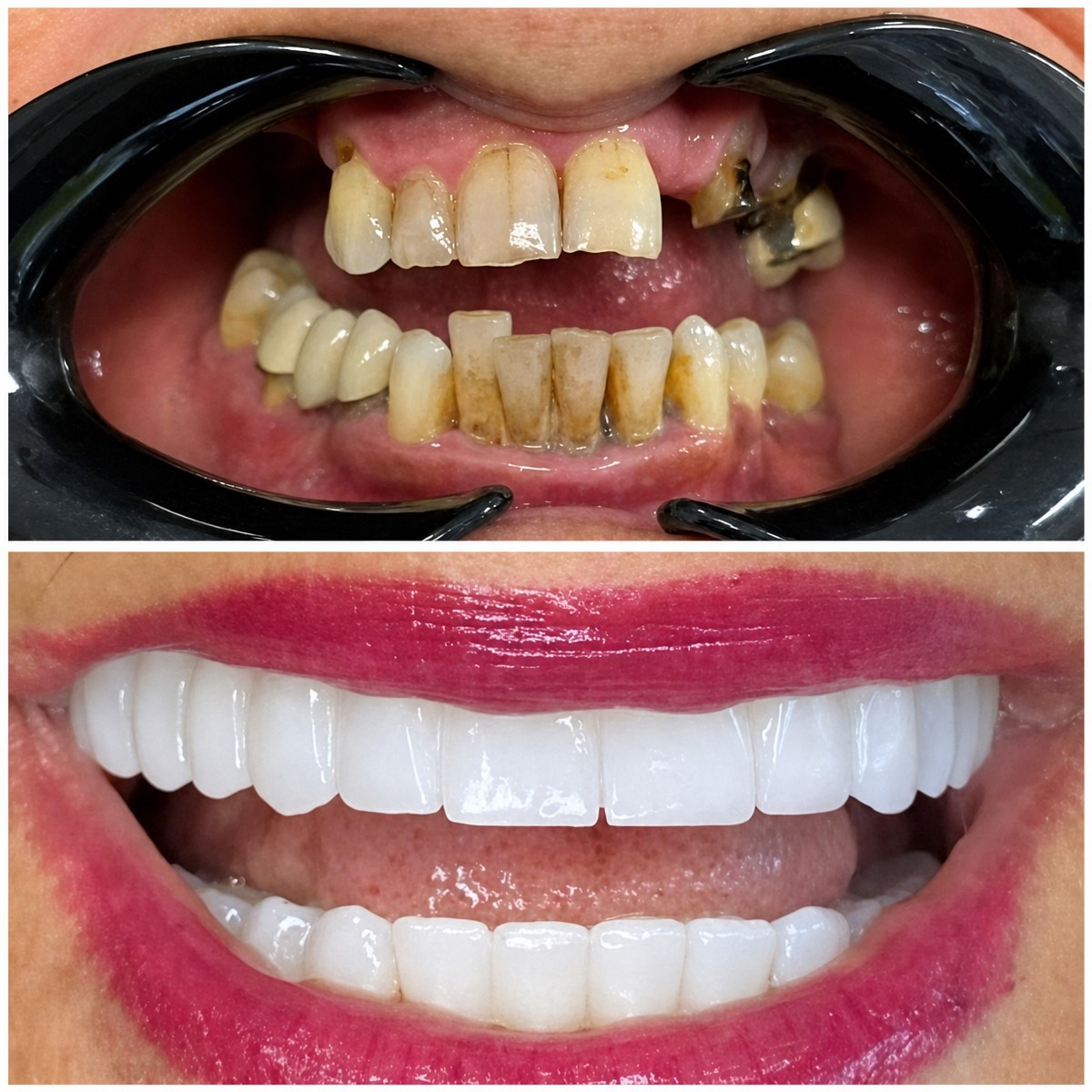 قبل وبعد تركيب تيجان الأسنان في Dental Med Austria & Elixence، نتيجة استعادة الابتسامة