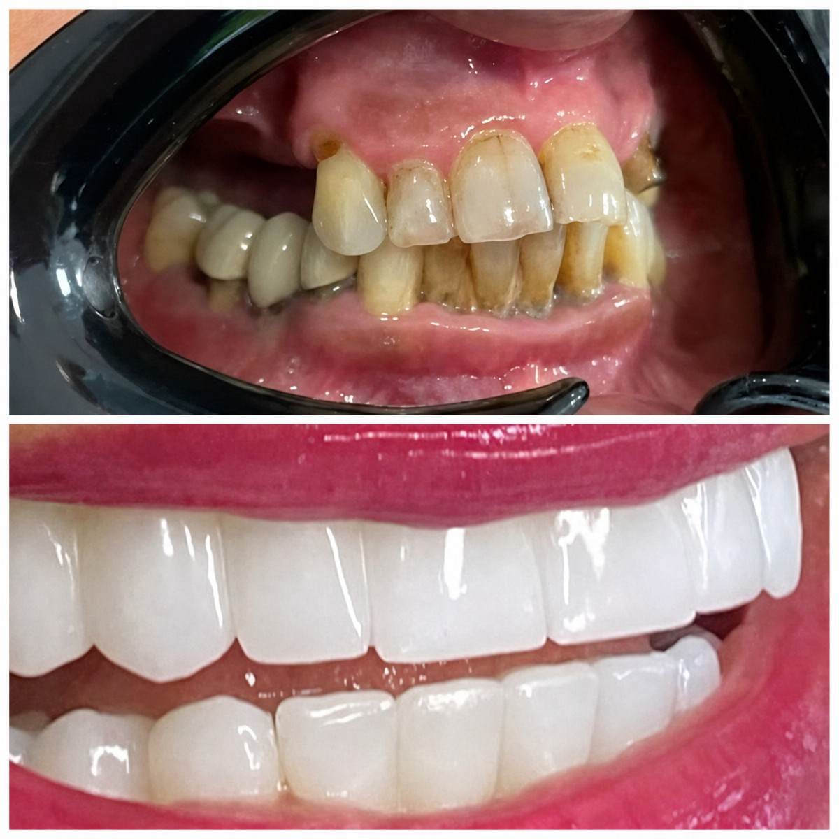 До та після встановлення зубних коронок у Dental Med Austria & Elixence, результат усмішки