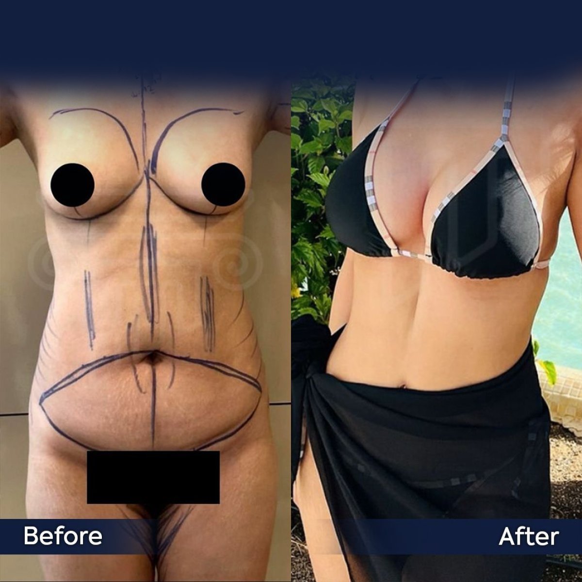 Mommy makeover before and after results at Dr. Safa Manav Clinic – body contouring transformation