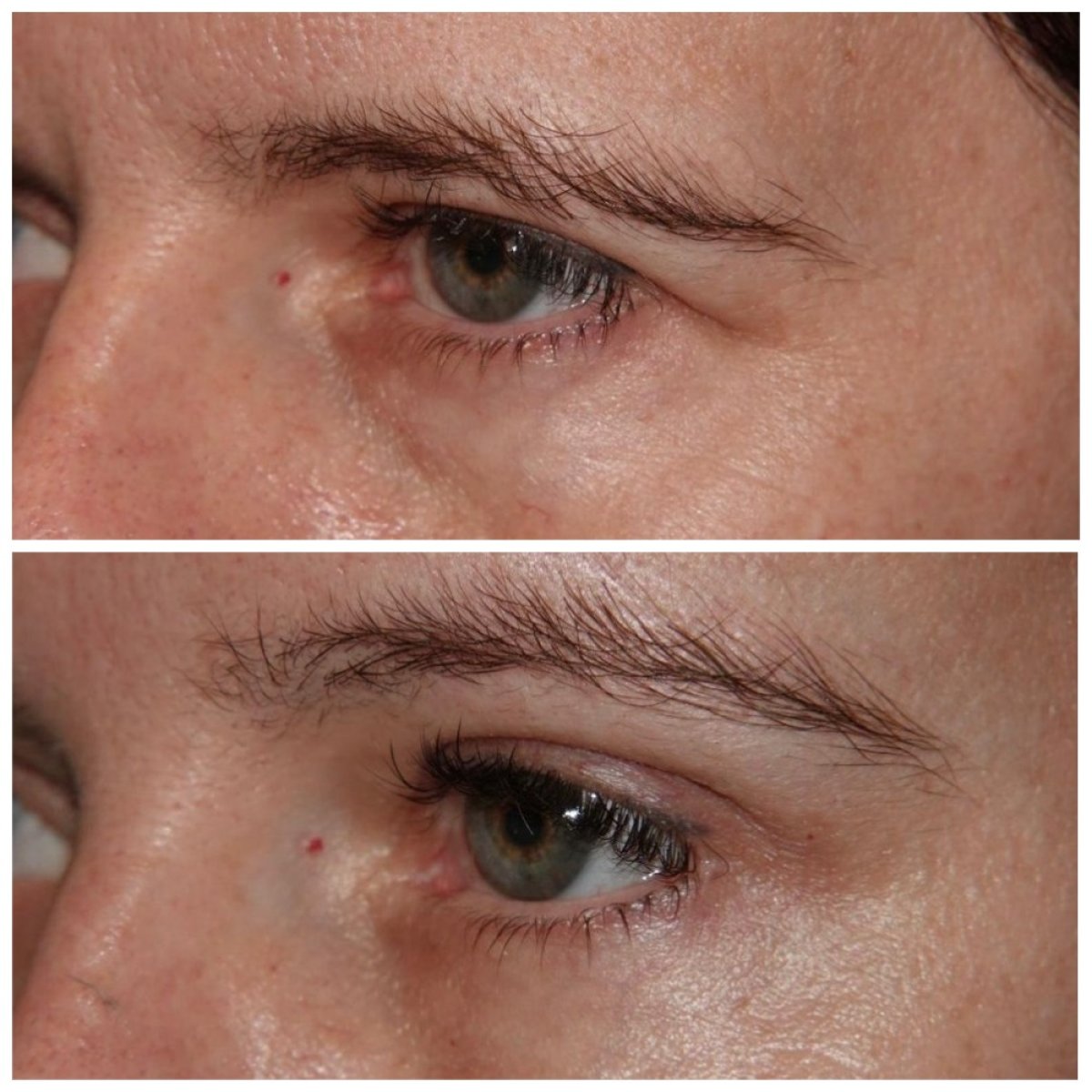 Before and after blepharoplasty results at Private Yüzyıl Hospital, eyelid correction improvement