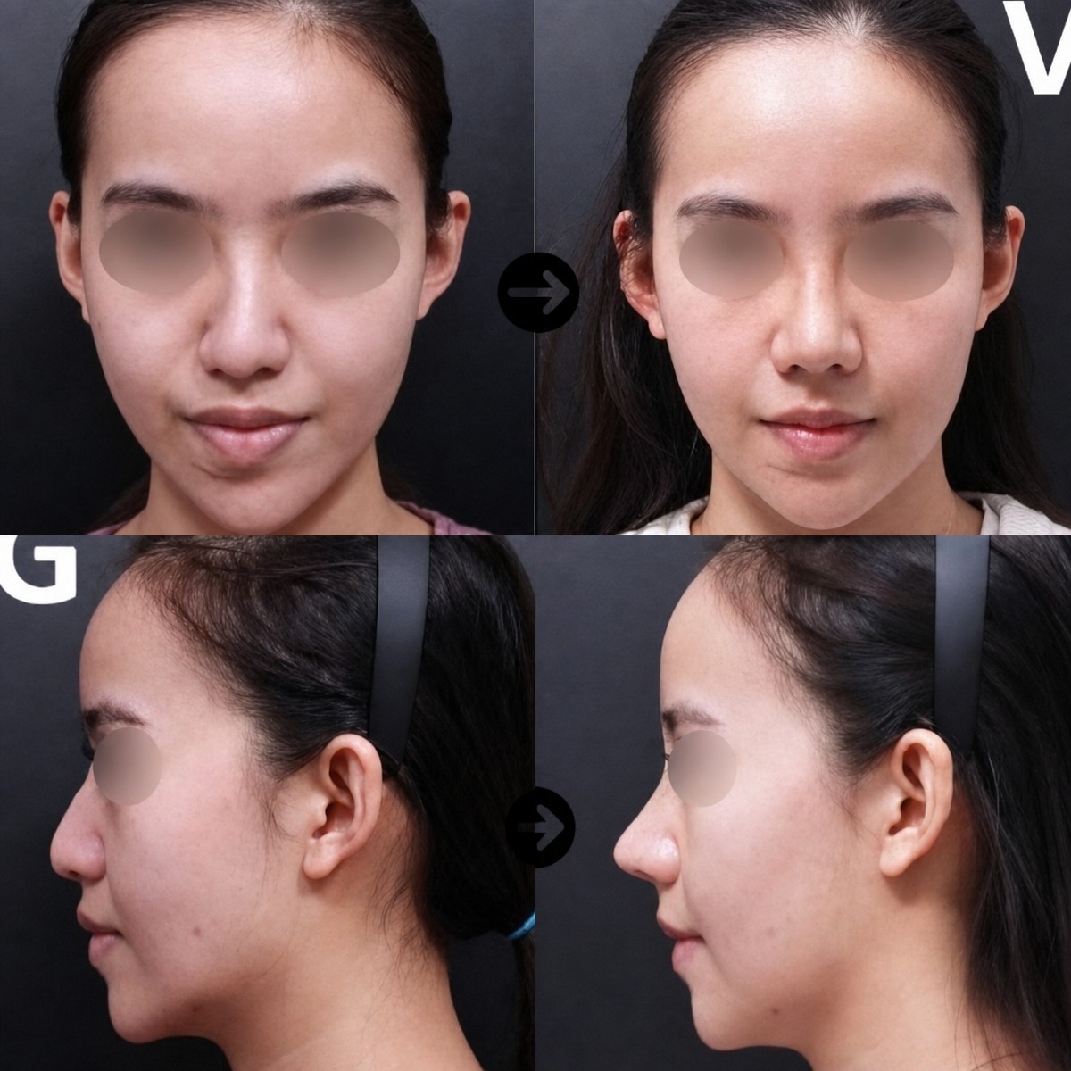 Before and after septoplasty results at VG Plastic Surgery, improved nasal symmetry and breathing