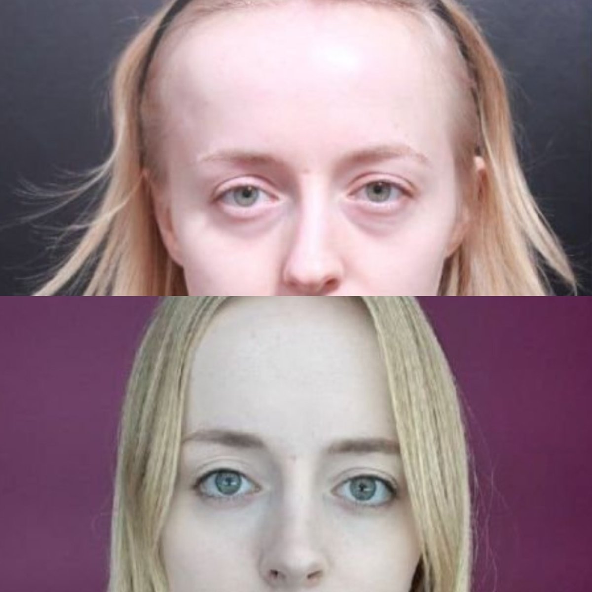 Resultados de septoplastia antes y después en VG Plastic Surgery, mejor simetría y respiración
