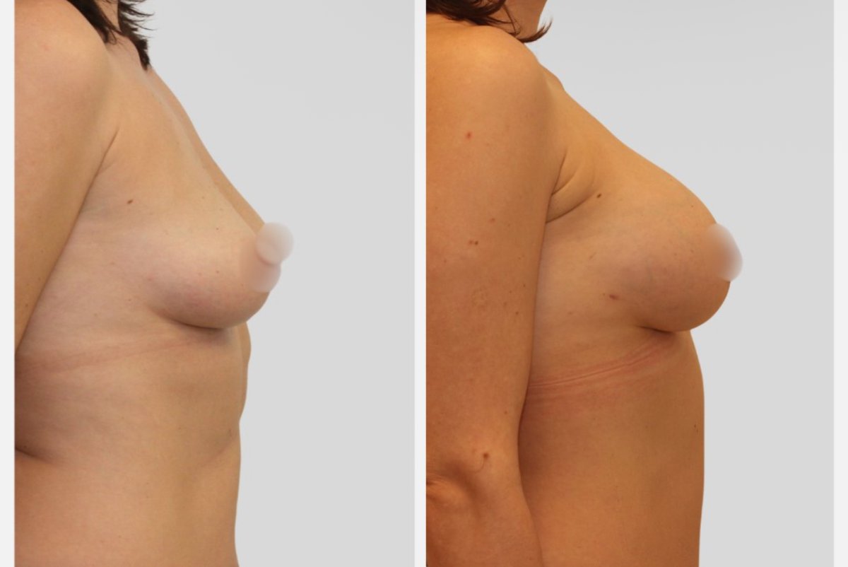 Before and after breast implants with breast lift results – enhanced breast shape and volume