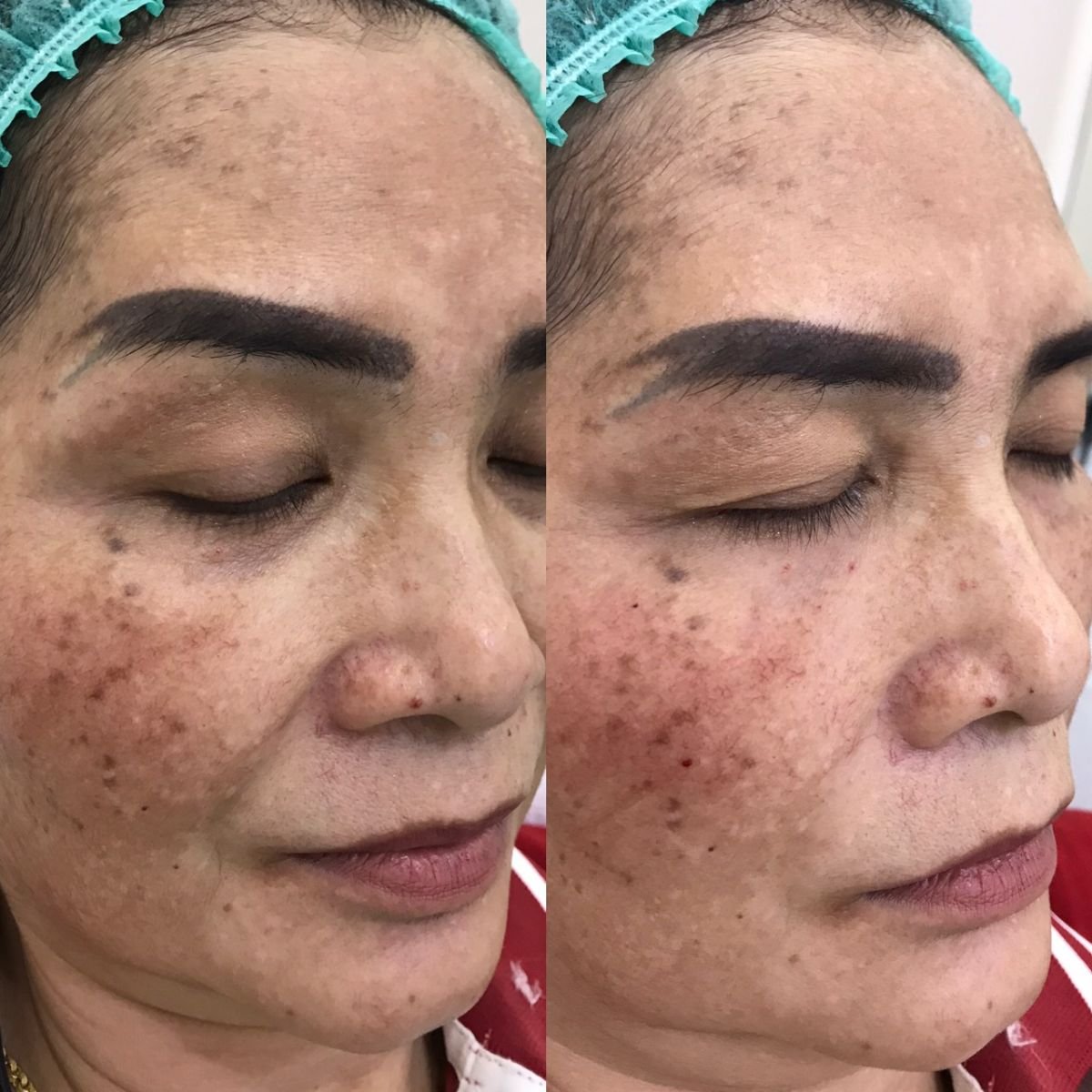 Antes y después de inyecciones de relleno en Asia Cosmetic Hospital, rejuvenecimiento facial visible