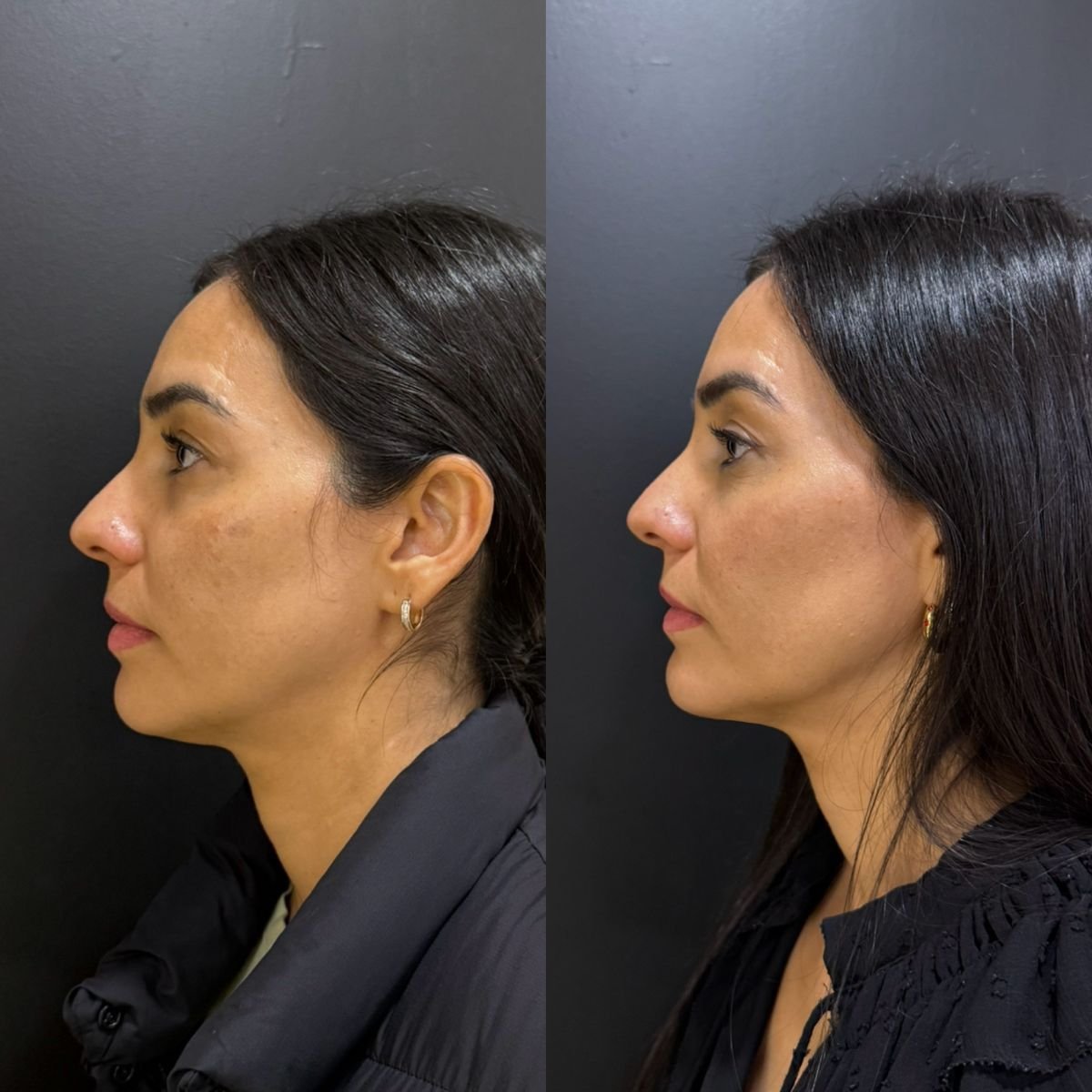 Before and after facial fat transfer results at Dr. Alexandro Aguilera - Plastic Surgery clinic