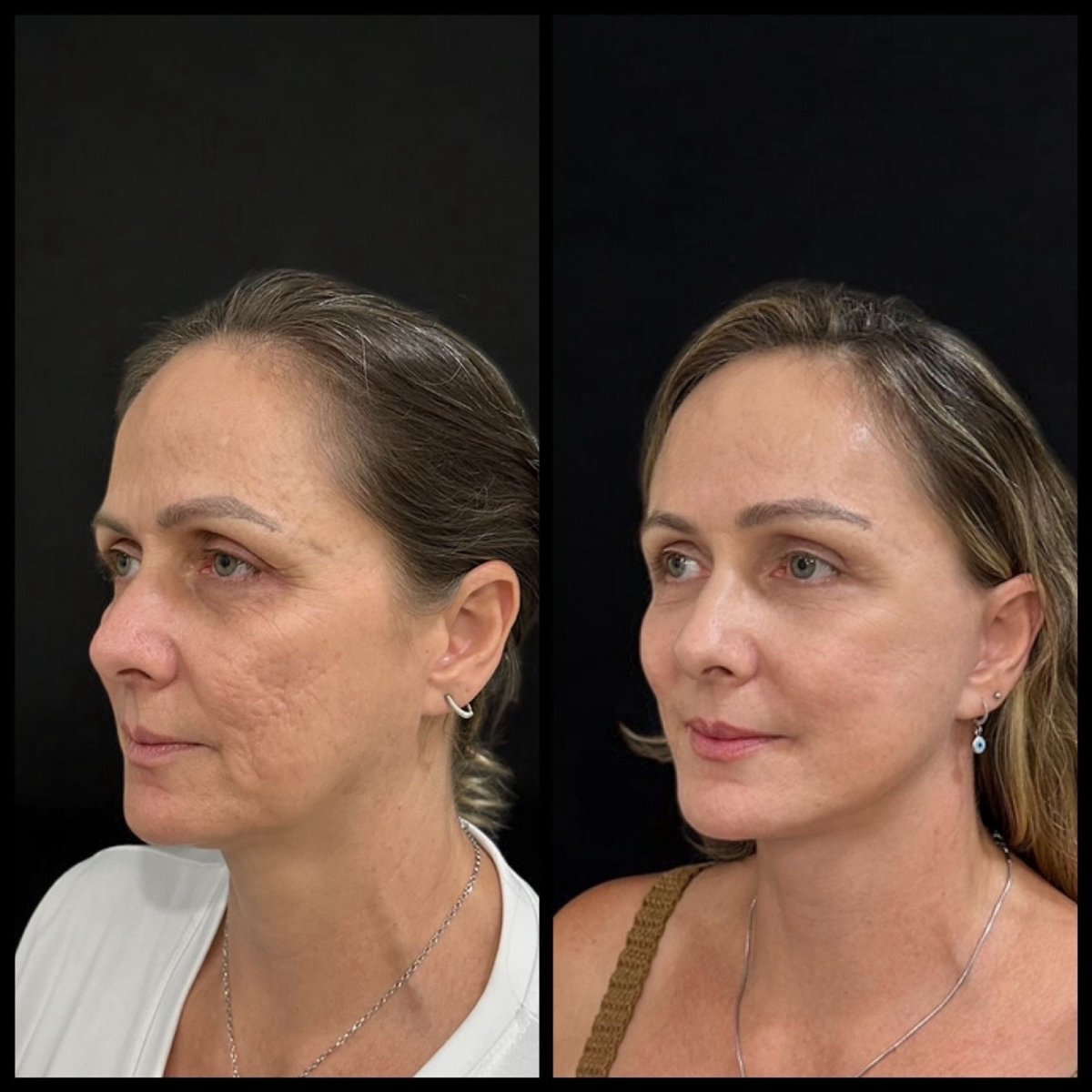 Результат до и после глубокого SMAS-лифтинга в Dr. Michel Salameh - Plastic And Aesthetic Surgery