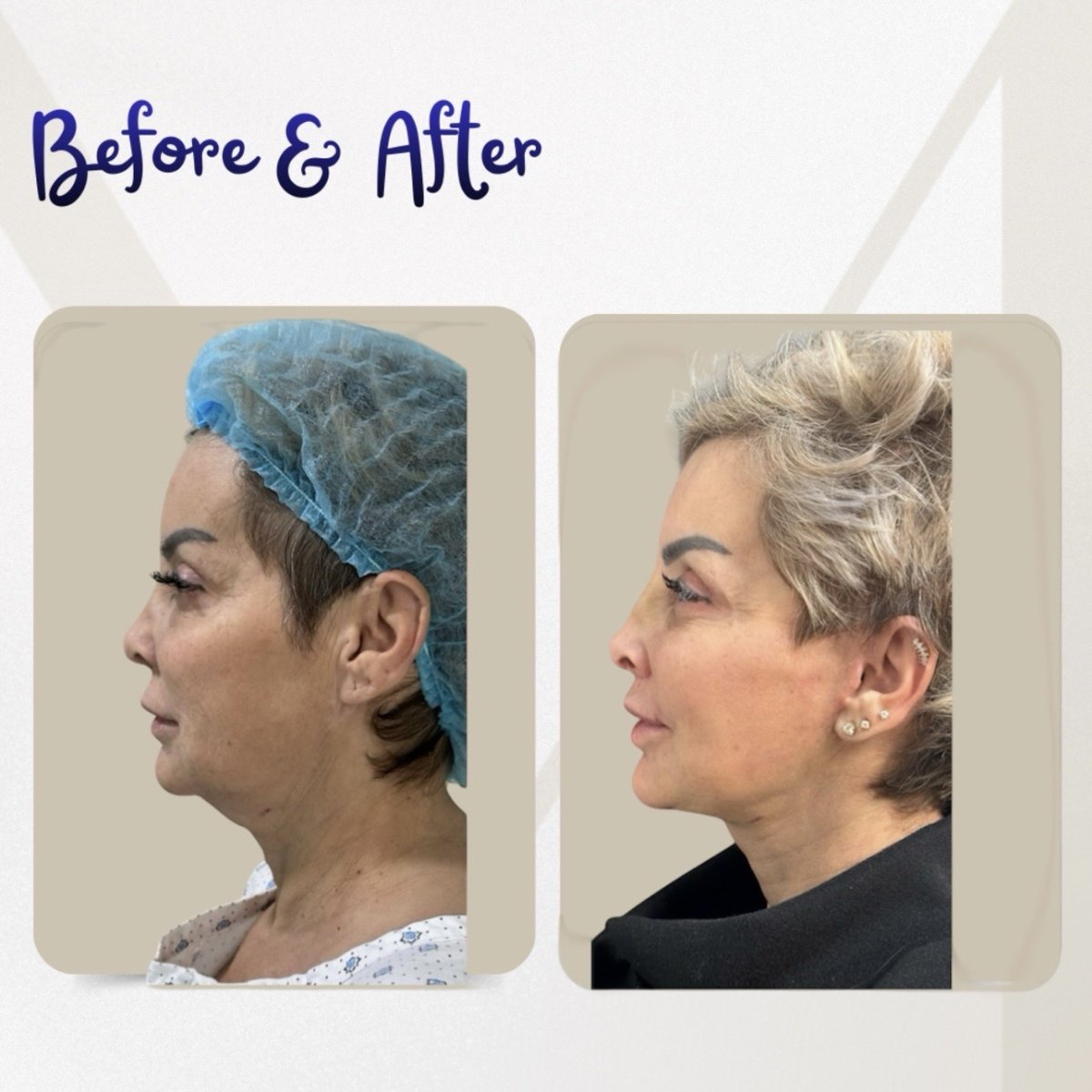 Before and after deep plane facelift result at Dr. Michel Salameh - Plastic And Aesthetic Surgery