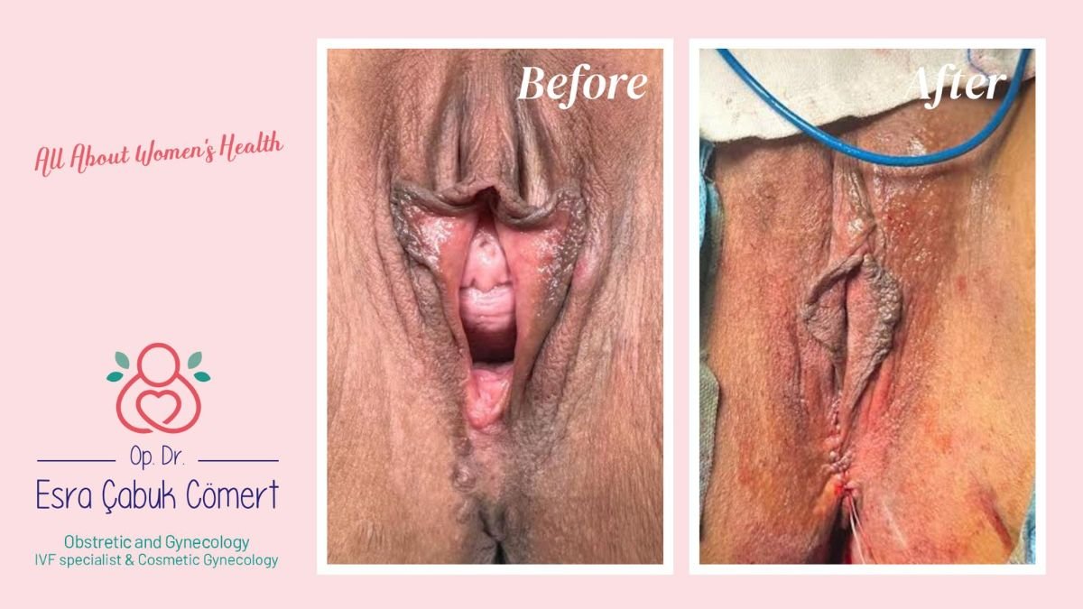 نتائج قبل وبعد عملية تجميل المهبل في عيادة د. إسراء تشابوك جومرت، مظهر محسّن