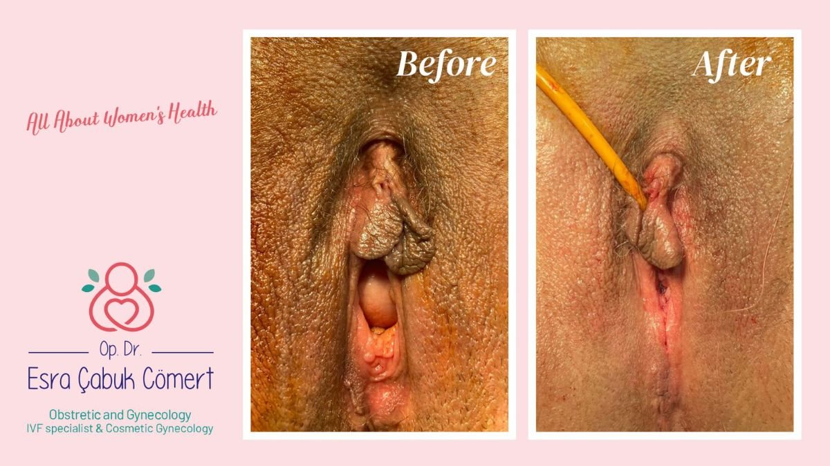 نتائج قبل وبعد عملية تجميل المهبل في عيادة د. إسراء جابوك جومرت، مظهر محسّن للمهبل