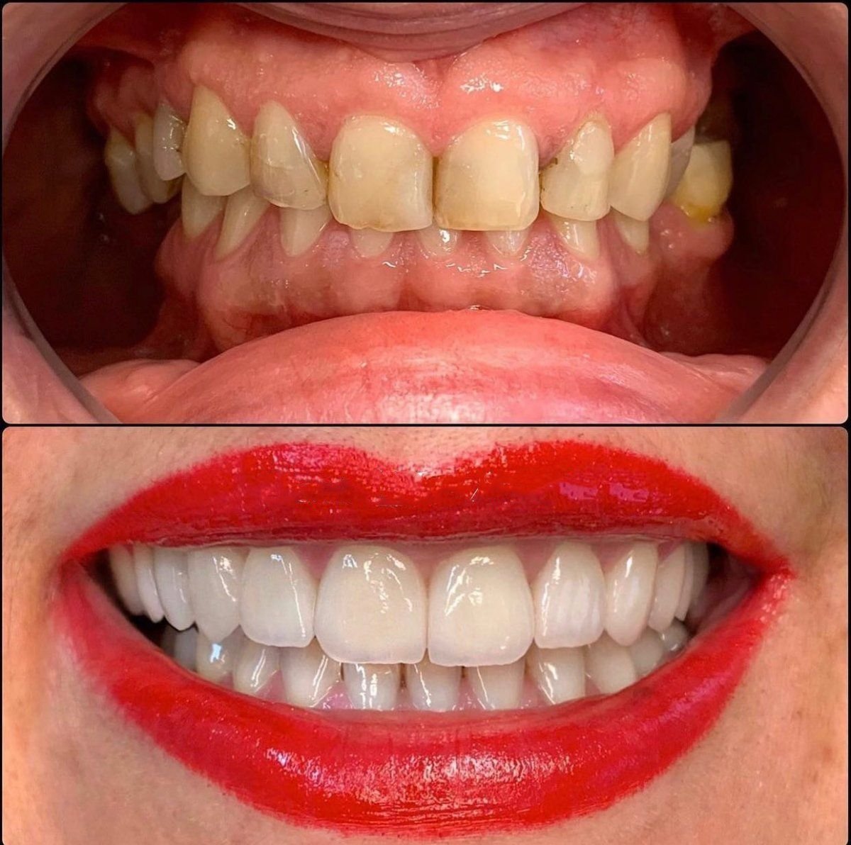 قبل وبعد تركيب تيجان الأسنان في Dental Med Austria & Elixence، نتيجة استعادة الابتسامة