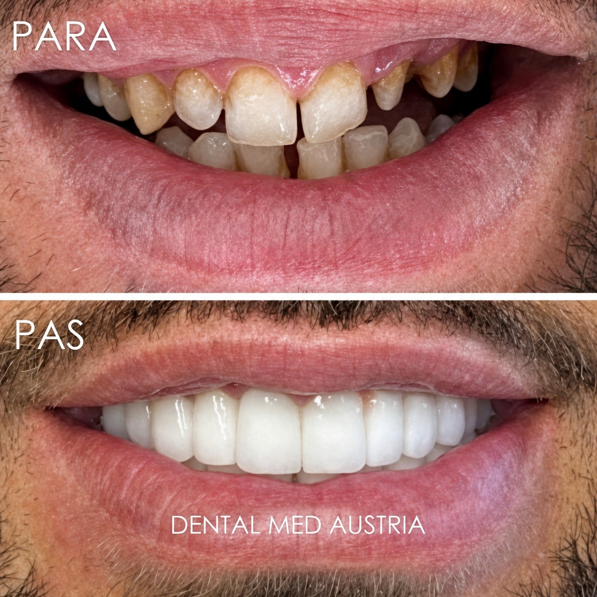 До и после установки зубных коронок в Dental Med Austria & Elixence, результат улыбки