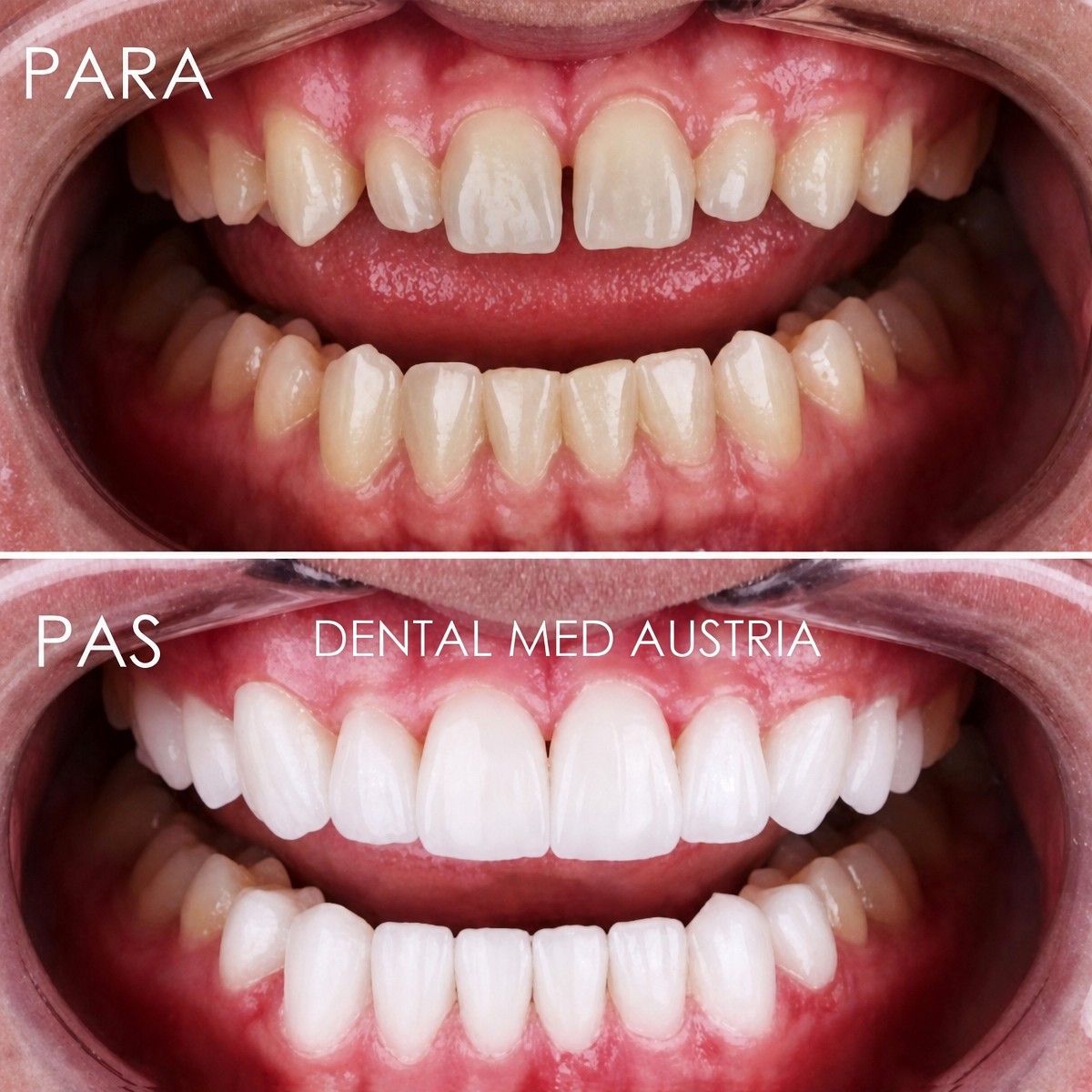 Результати до і після встановлення коронок у Dental Med Austria & Elixence, зміна посмішки