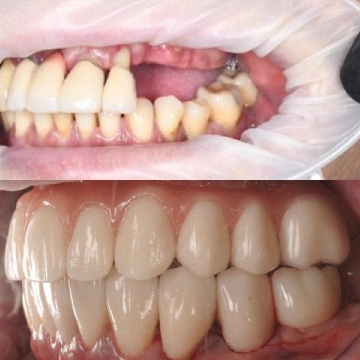 Resultados antes y después de Hollywood Smile en RIKOTA Dental Clinic – restauración dental total
