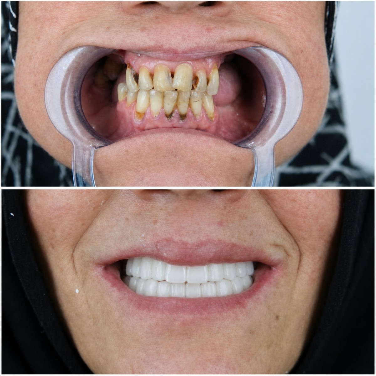 نتائج قبل وبعد استبدال تيجان الأسنان في YEG Clinic – ابتسامة محسنة