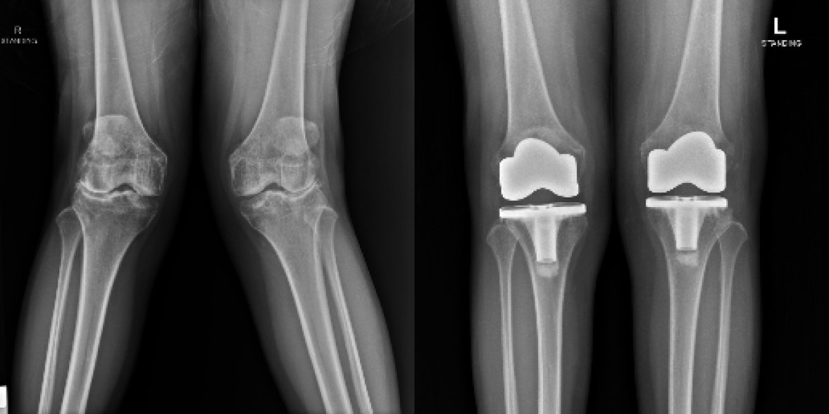Résultats avant/après révision prothèse totale du genou à LUX KOR Hospital, alignement amélioré