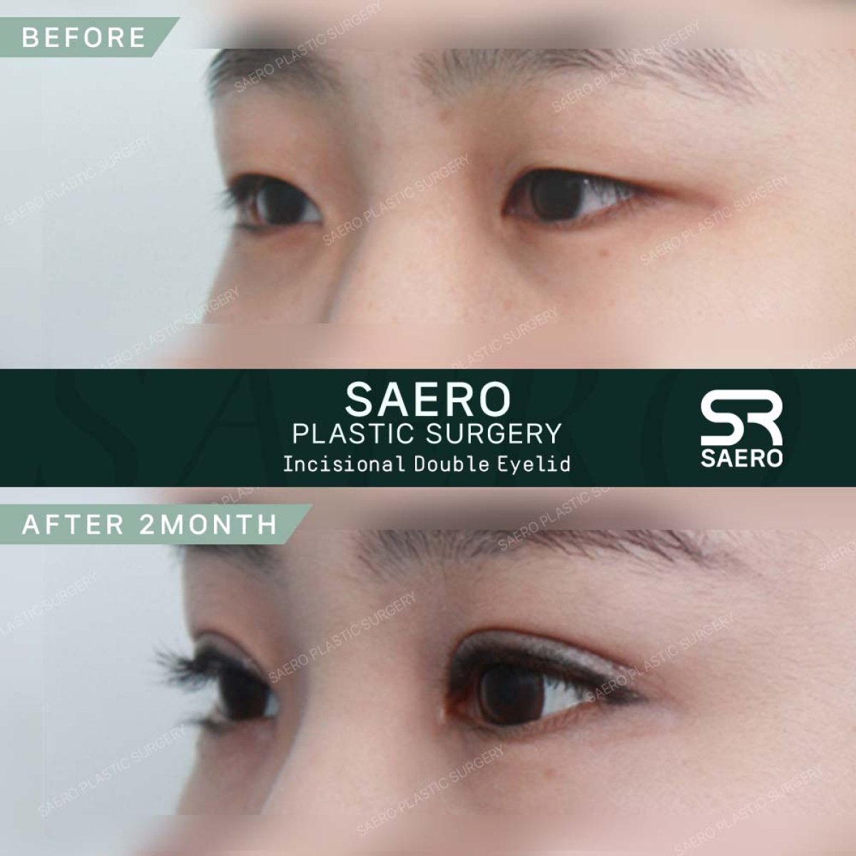 Résultats avant et après chirurgie des paupières chez SAERO Plastic Surgery, 2 mois post-op