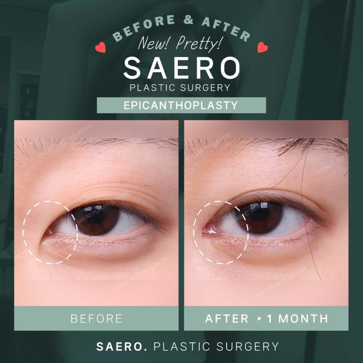 نتائج قبل وبعد جراحة الإبيكانثوبلاستي في SAERO Plastic Surgery، تحسين شكل العين