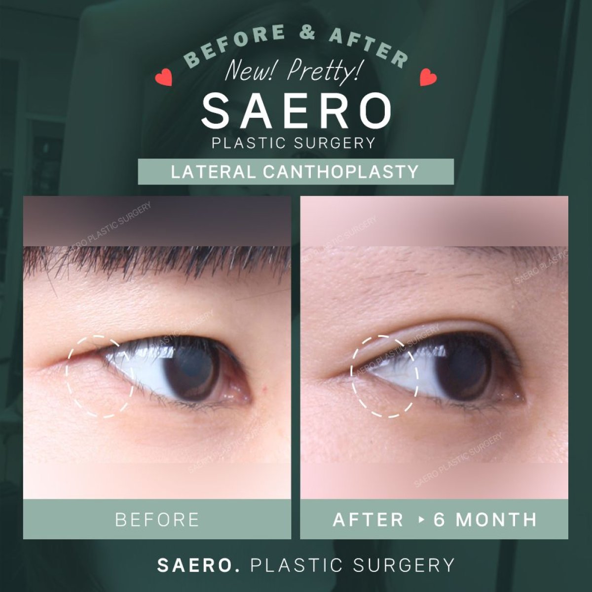 Before and after cat eye surgery (canthoplasty) results at SAERO Plastic Surgery clinic