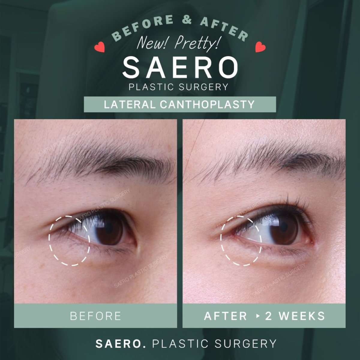 Resultados de cirugía cat eye (canthoplastia lateral) antes y después en SAERO Plastic Surgery