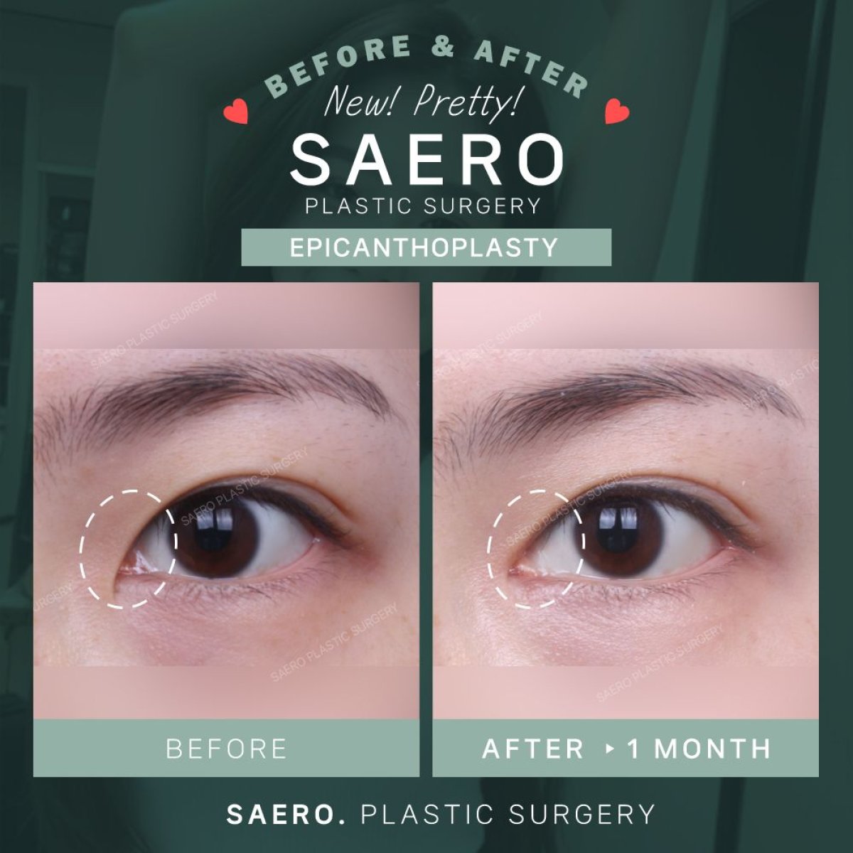 نتائج قبل وبعد جراحة الإبيكانثوبلاستي في SAERO Plastic Surgery، تحسين شكل العين