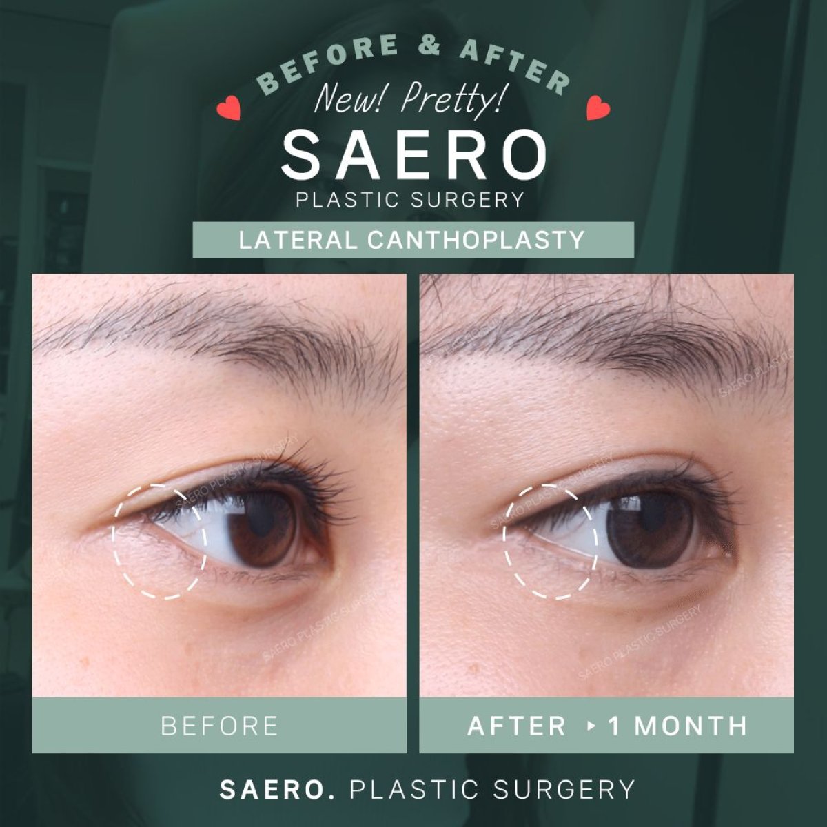 Résultats avant/après canthoplastie cat eye à la clinique SAERO Plastic Surgery