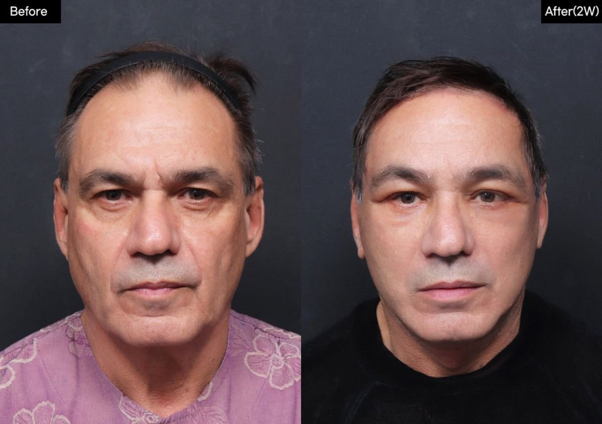 نتائج شد الوجه العميق قبل وبعد في VG Plastic Surgery، تجديد شباب الوجه بوضوح