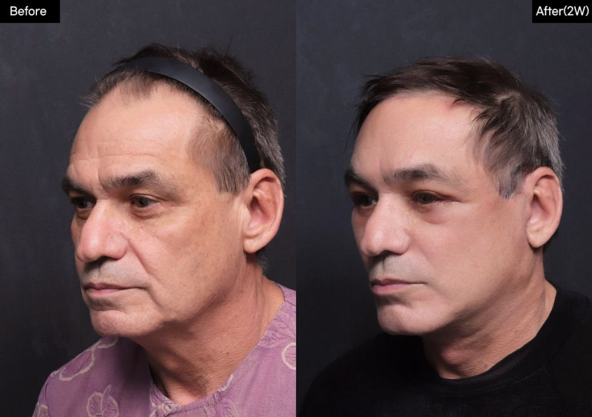 Результат до и после deep plane SMAS-лифтинга в VG Plastic Surgery, видимое омоложение лица