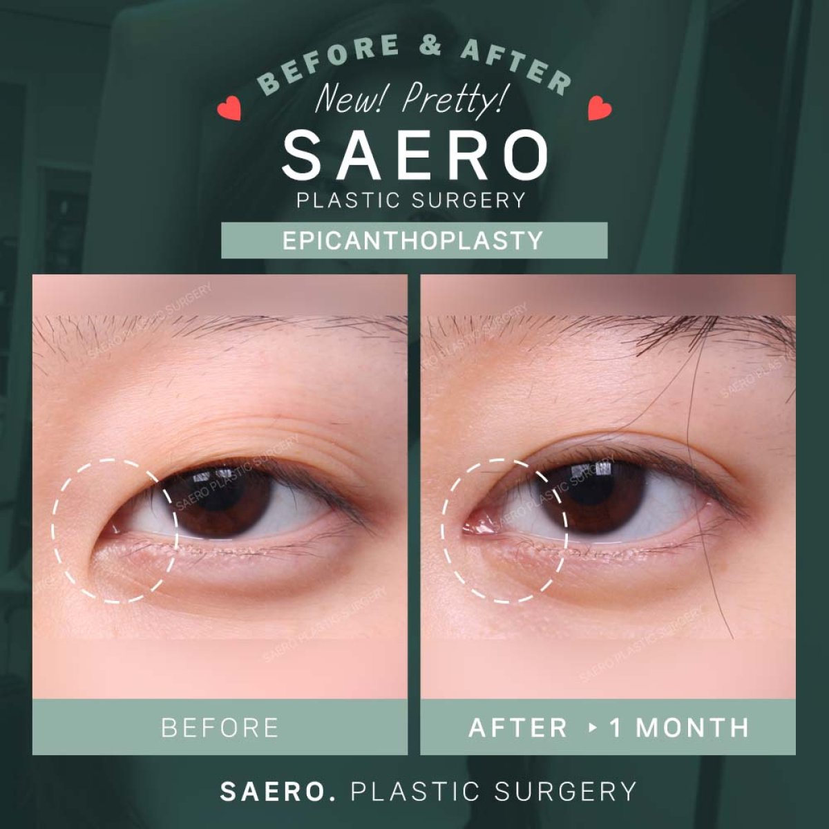 نتائج قبل وبعد رأب الجفن الداخلي في SAERO Plastic Surgery، تحسين شكل العين