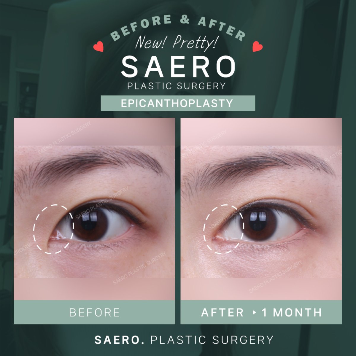 نتائج قبل وبعد رأب الجفن الداخلي في SAERO Plastic Surgery، تحسين شكل العين
