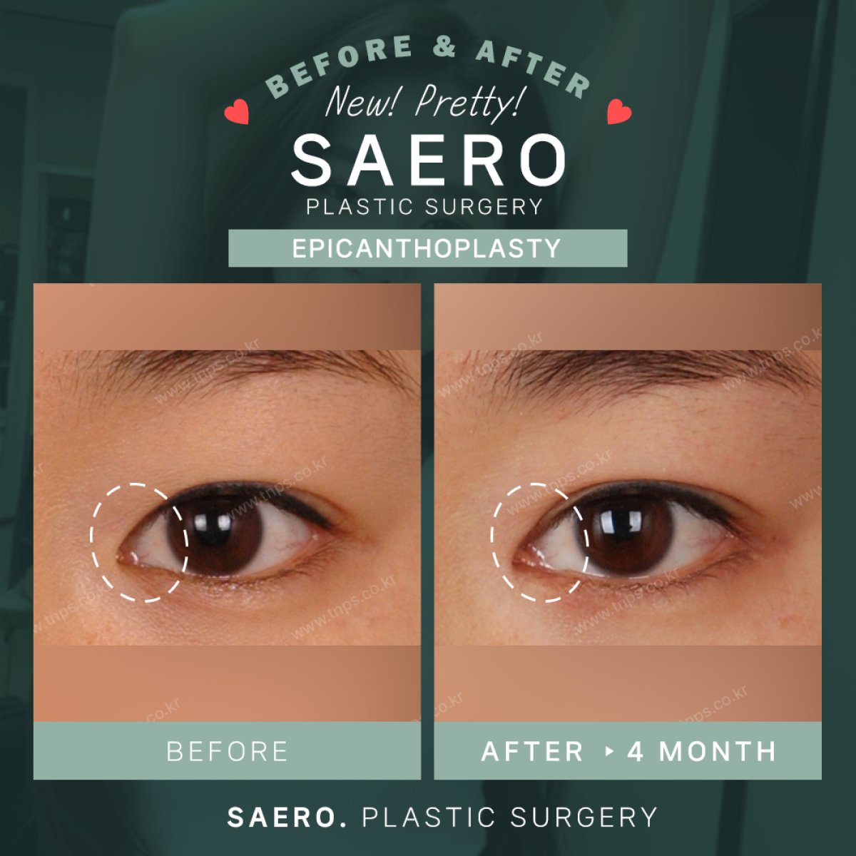 نتائج قبل وبعد جراحة رأب الجفن الداخلي في SAERO Plastic Surgery، تحسين شكل العين
