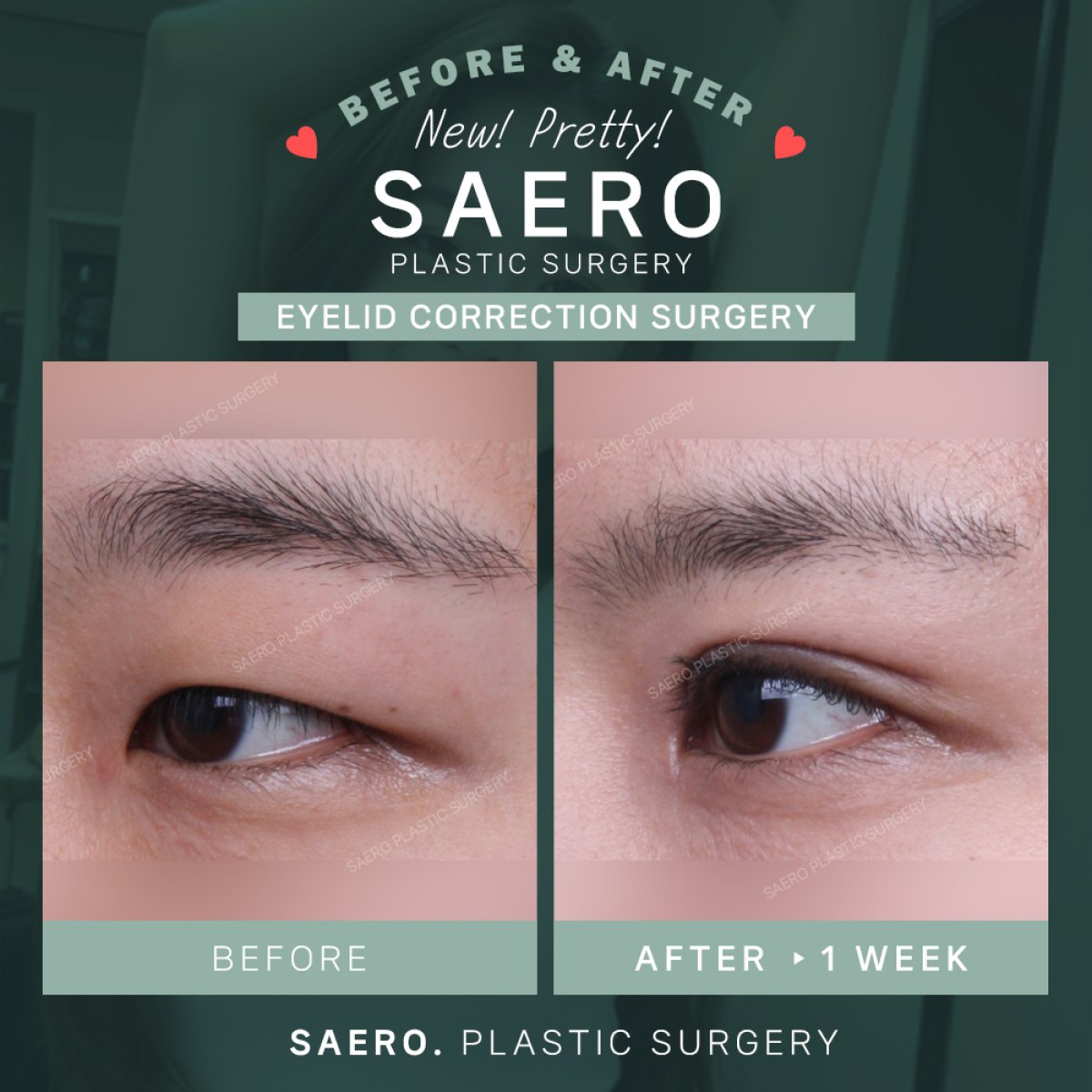 نتائج قبل وبعد جراحة الجفن المتدلي في SAERO Plastic Surgery، مظهر عين محسّن