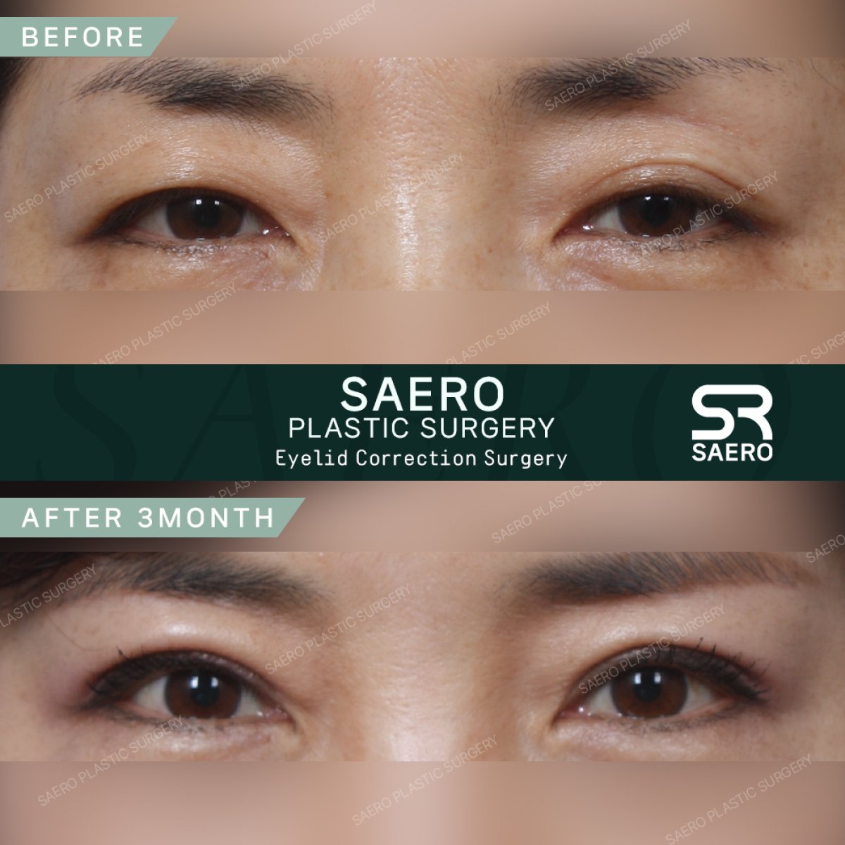 نتائج عملية الجفن المترهل قبل وبعد في SAERO Plastic Surgery، مظهر عين محسّن