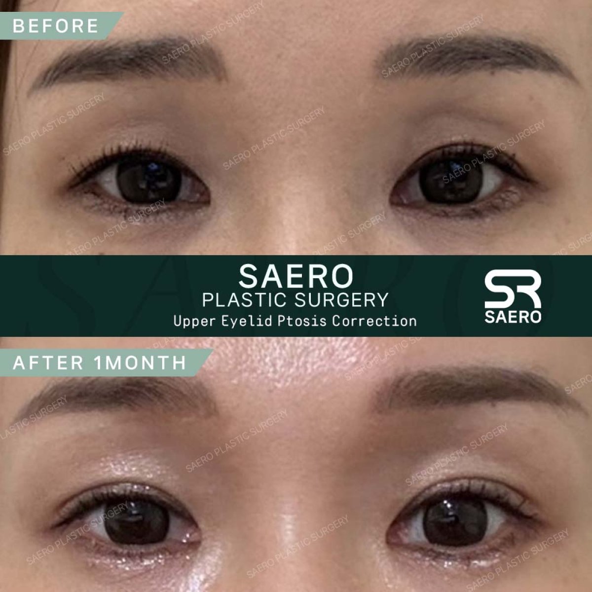 Vorher-nachher-Ergebnis der Schlupflid-OP bei SAERO Plastic Surgery, verbesserte Lidkontur