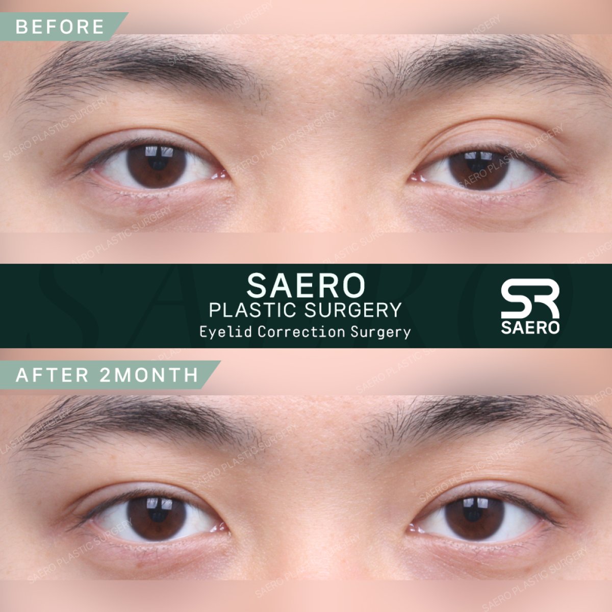 نتائج قبل وبعد جراحة الجفن المتدلي في SAERO Plastic Surgery، تحسين شكل الجفن