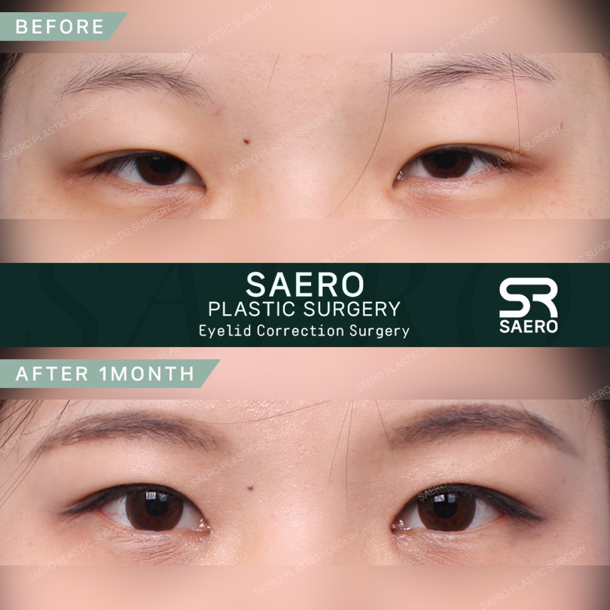 Результаты до и после операции на опущенных веках в SAERO Plastic Surgery, улучшенный вид глаз