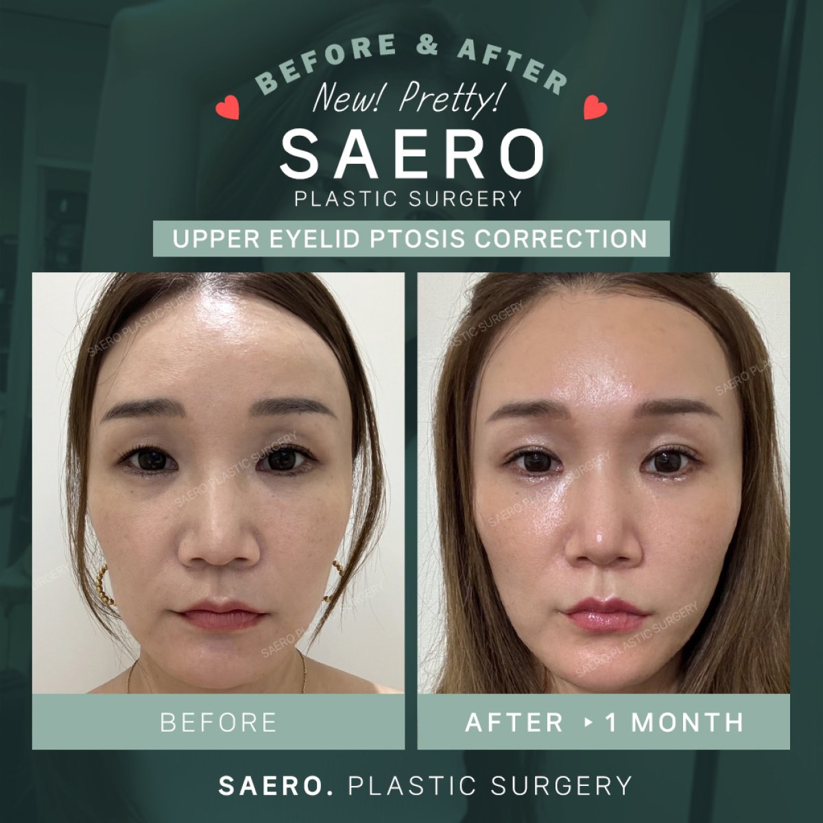 Résultats avant et après chirurgie des paupières tombantes chez SAERO Plastic Surgery, correction ptosis