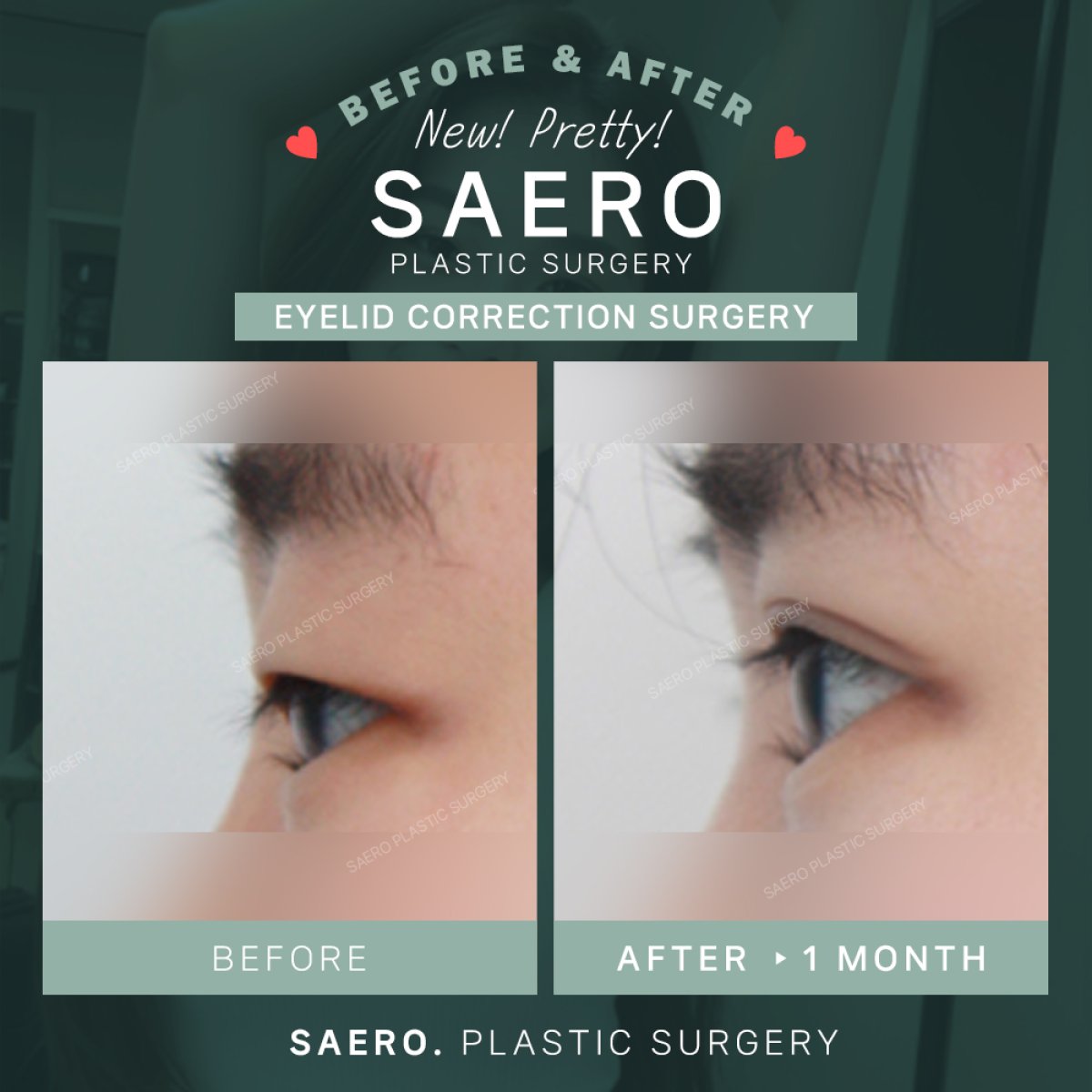 نتائج قبل وبعد جراحة الجفن المتدلي في SAERO Plastic Surgery، تحسين شكل الجفن