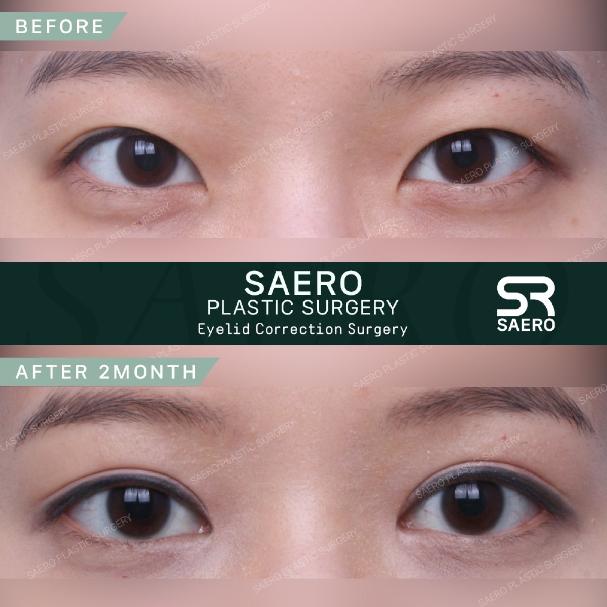 نتائج قبل وبعد جراحة الجفن المتدلي في SAERO Plastic Surgery، مظهر عين محسّن