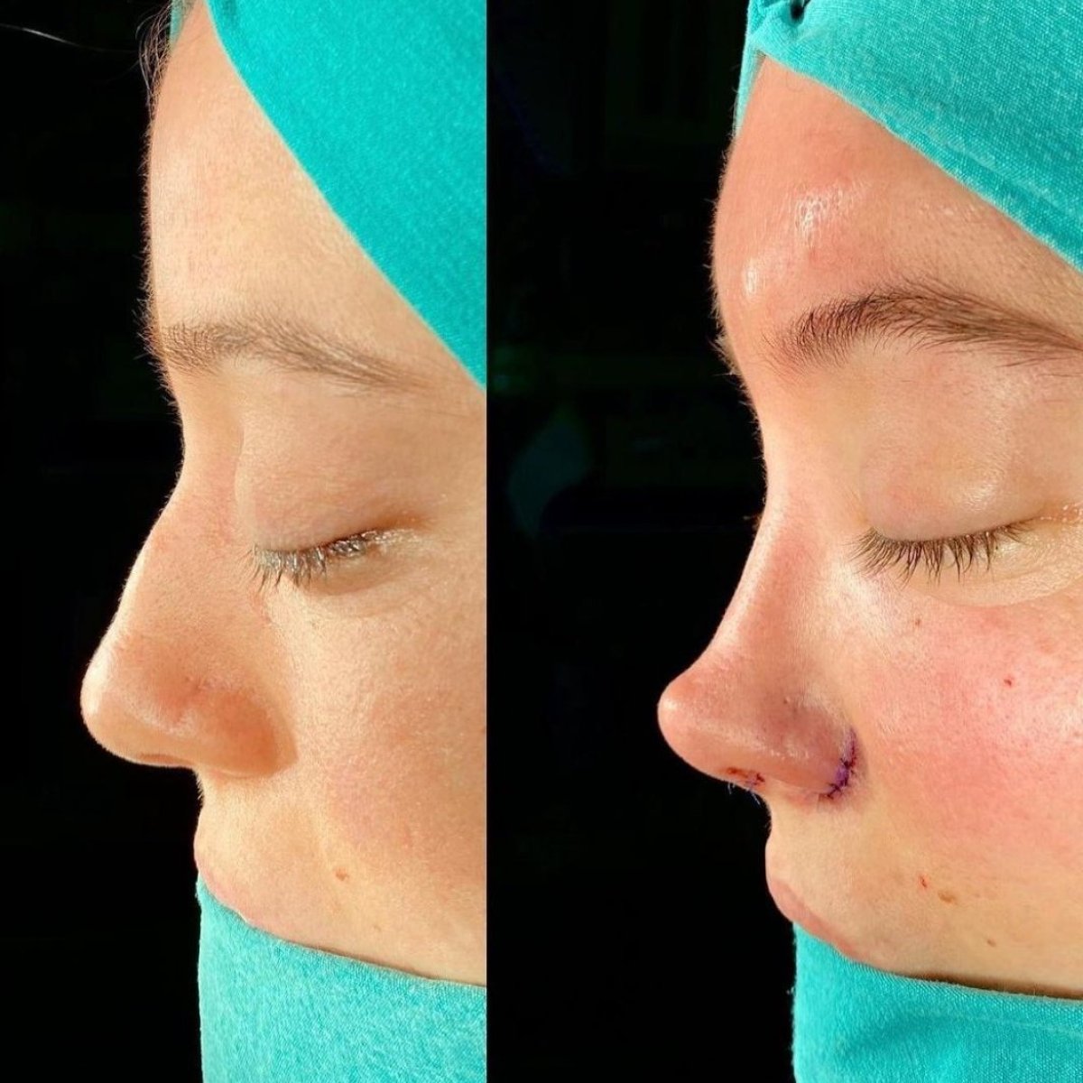 نتائج عملية تجميل الأنف قبل وبعد في مستشفى Private Yüzyıl، إعادة تشكيل الأنف
