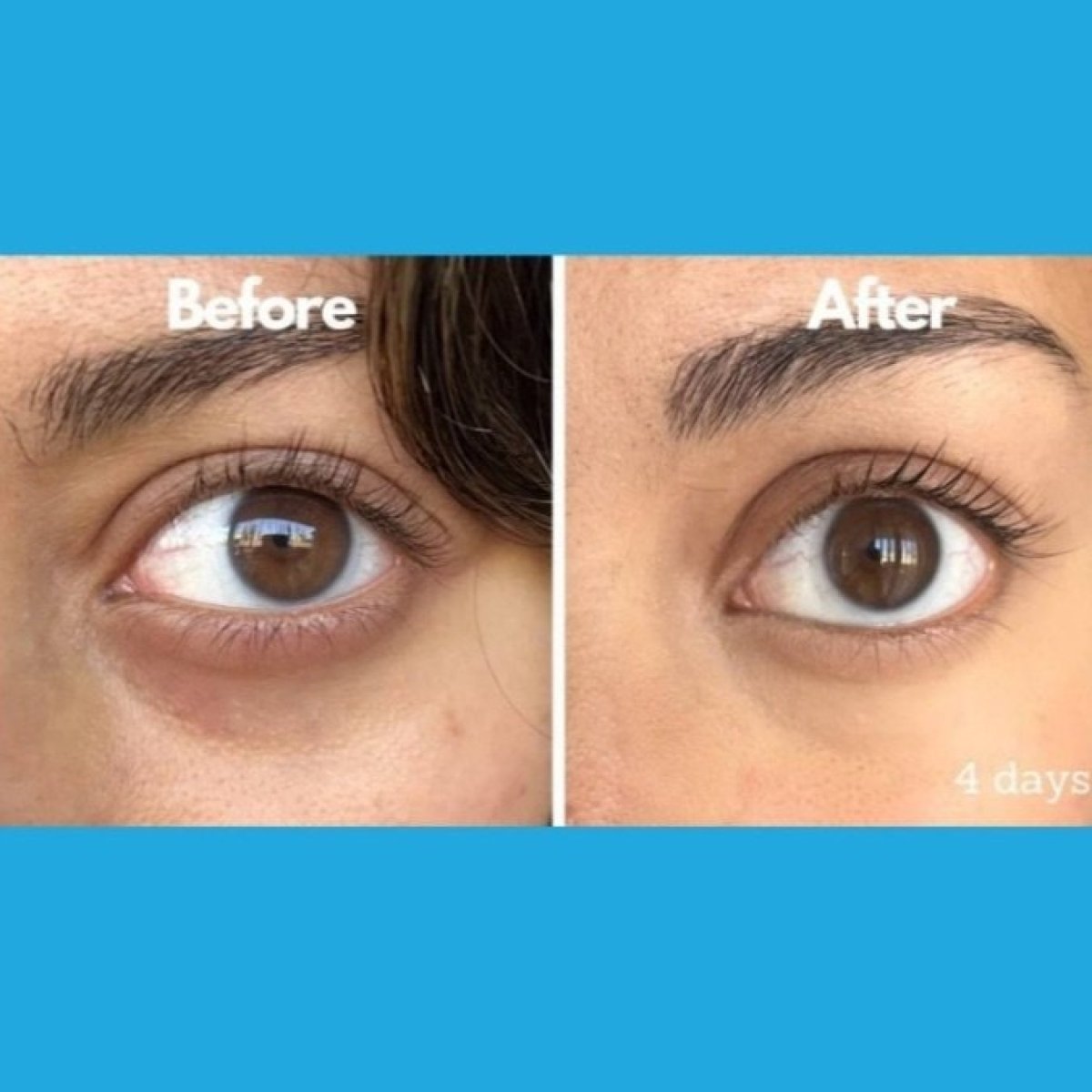 Before and after skin rejuvenation under eyes at ID Clinic Bangkok, visible dark circle reduction result